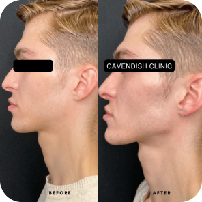 Dermal filler, cheek, chin and nose results by Cavendish Clinic.