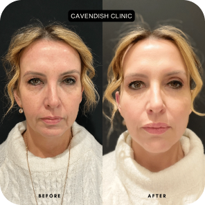 Full face dermal filler results by Cavendish Clinic