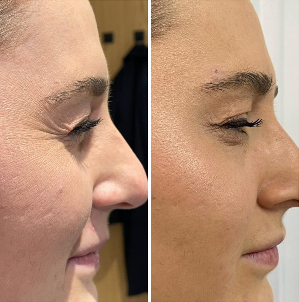 Crows feet with Anti-Wrinkle, results by Cavendish Clinic.