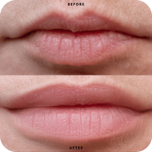 Lip filler 1ml results by Cavendish Clinic