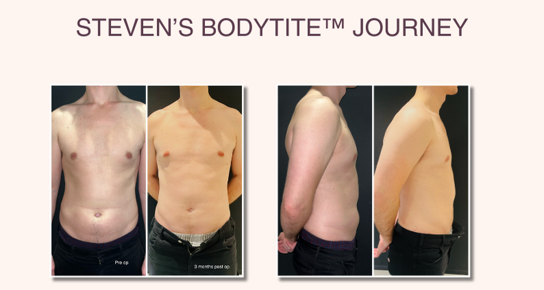 Steven's-BodyTite™-Journey