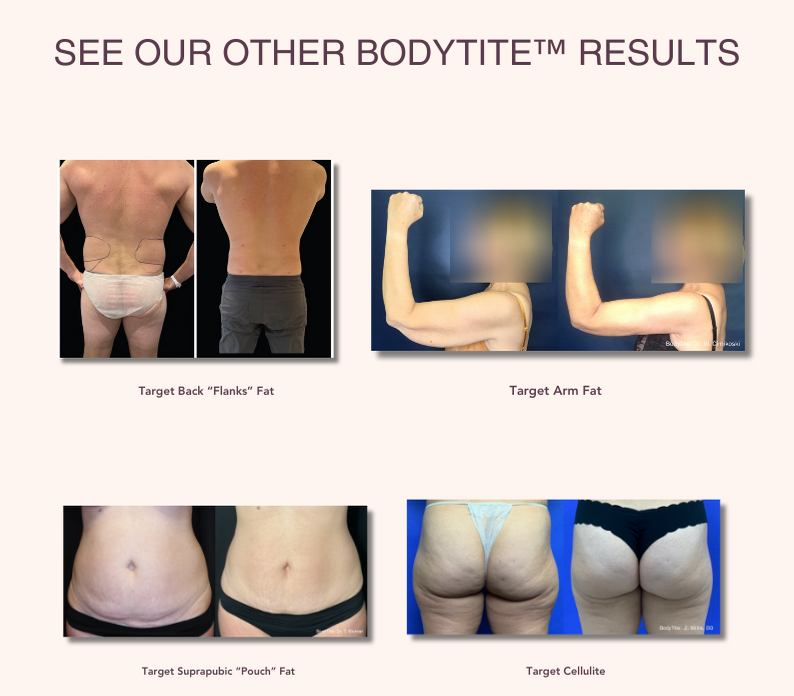 BodyTite™-Results
