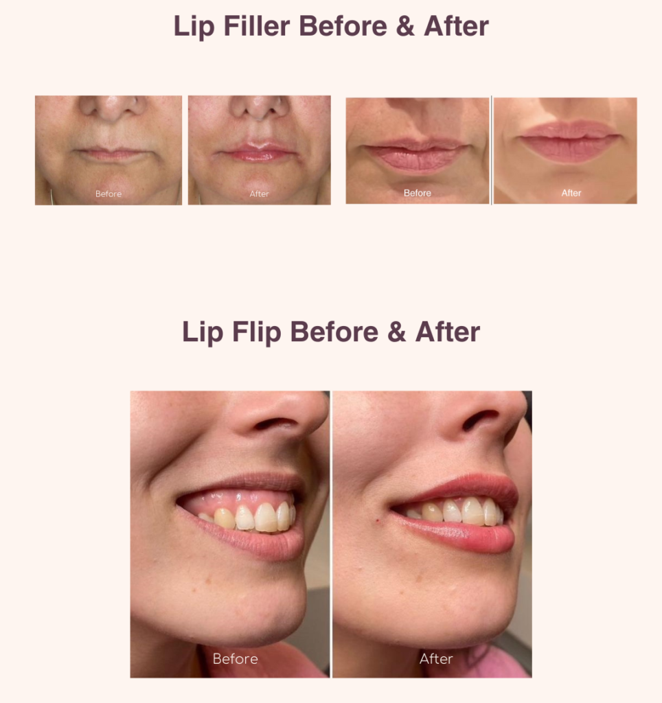 Lip-filler-before-and-after